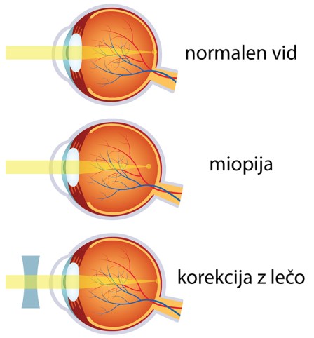Miopija