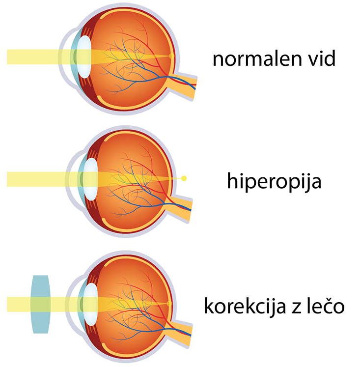 Hiperopija